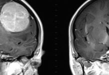 Mitochondrial 'smart bomb' could treat brain tumors