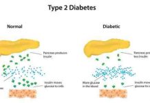 Type II diabetes: weekly nutrition classes increase condition