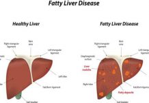 World Liver Day 2018: Follow the diet plan recommended by using a nutritionist to manage fatty liver