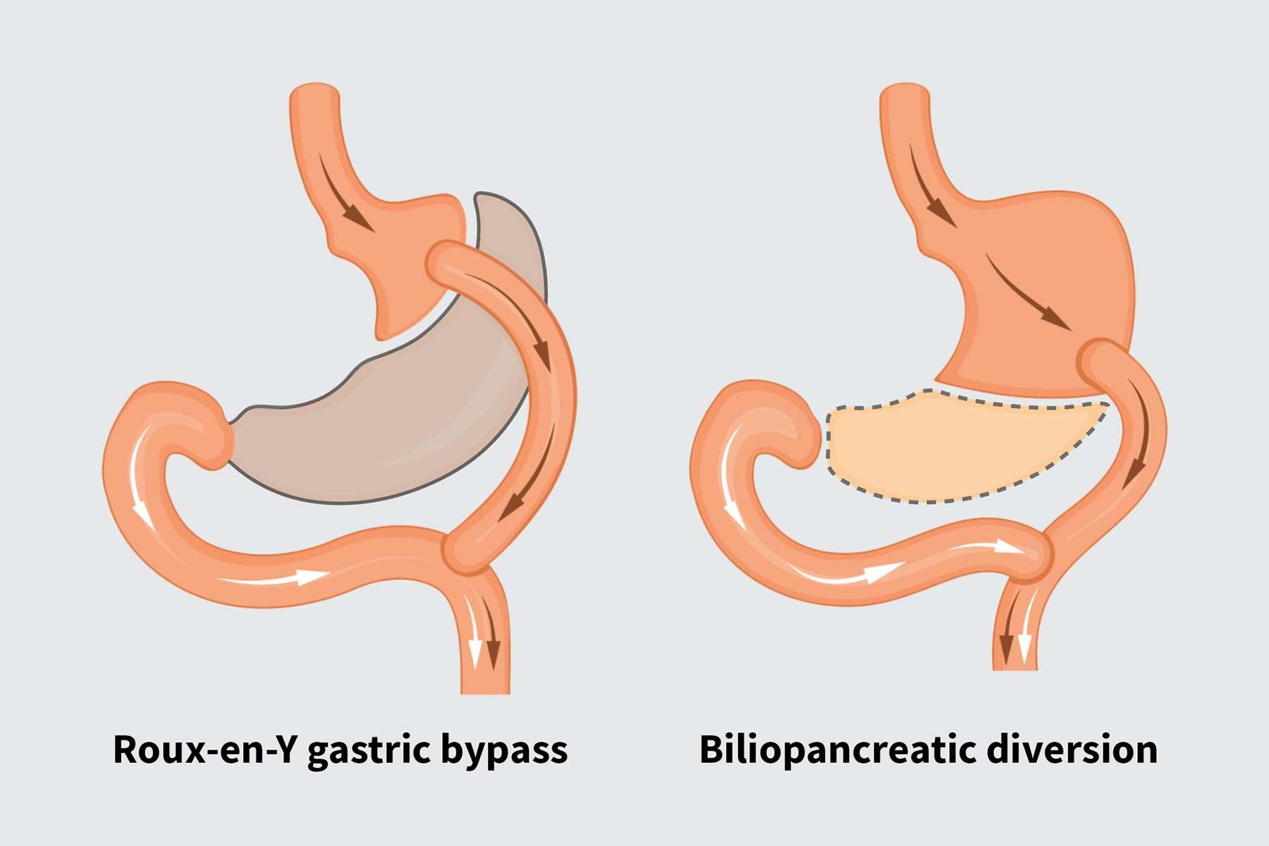 Guidelines for Choosing the Right Surgical Option